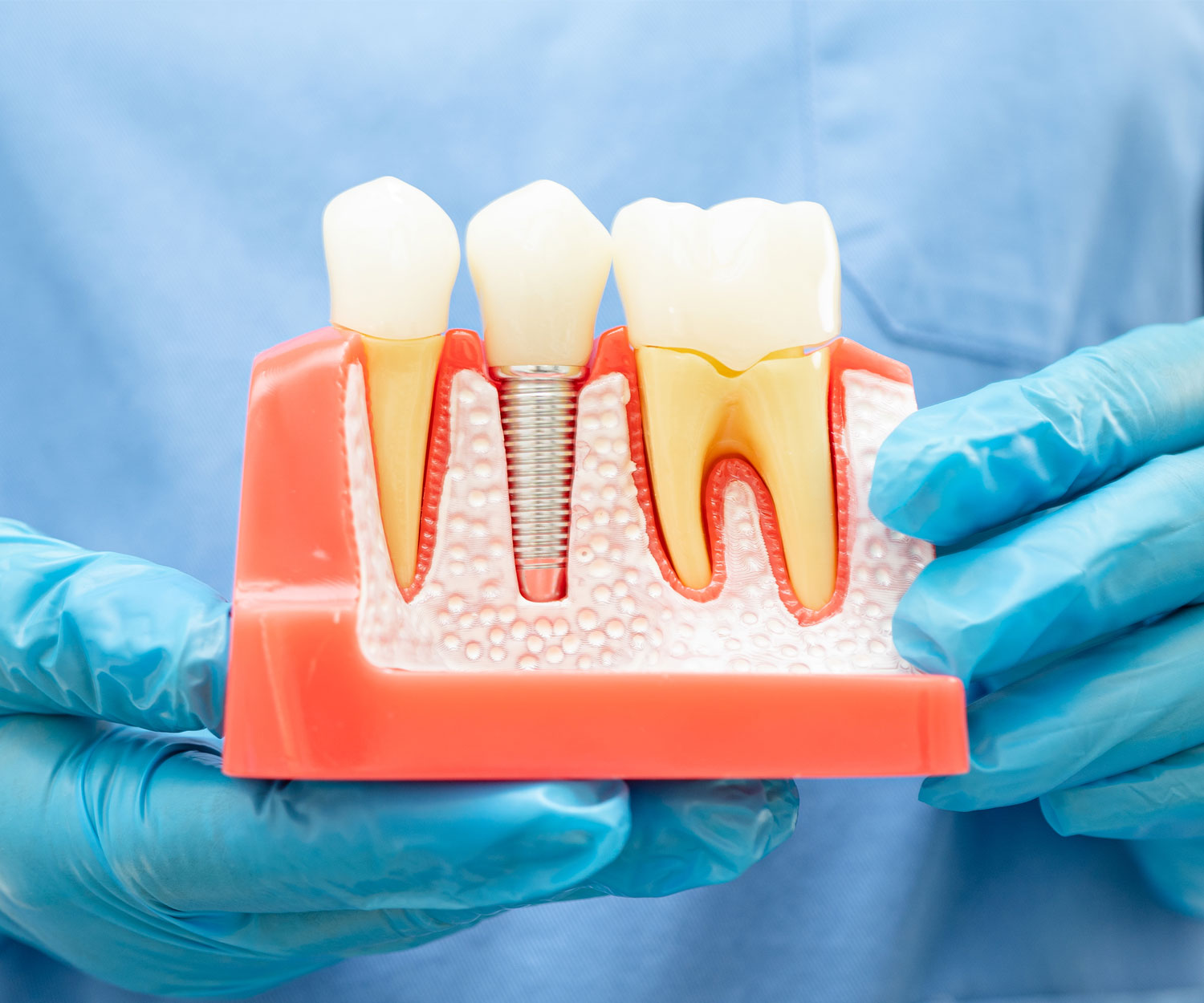 https://www.fyplusdental.com/wp-content/uploads/2024/03/implant.jpg